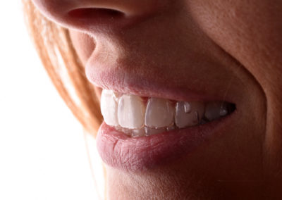 Ortodonzia Invisalign
